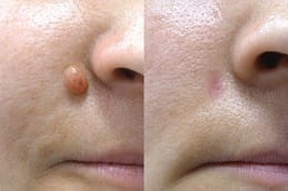 Skin Tag Removal Cost In Riyadh