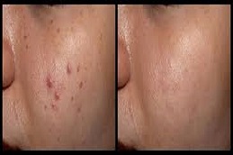 Best Pimples Treatment Riyadh
