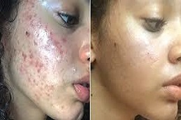 Pimples Treatment Clinic in Riyadh