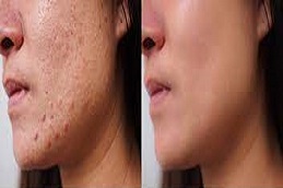 Pimples Treatment Cost in Riyadh