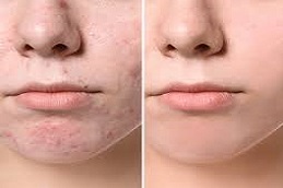 Pimples Treatment Riyadh