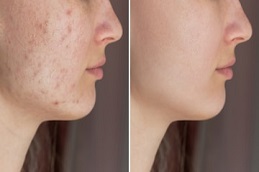 Pimples Treatment in Riyadh