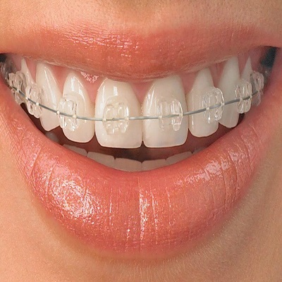 Ceramic Braces for Teeth Straightening in Riyadh & Saudi Arabia Cost