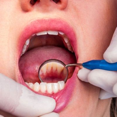 Dental Tooth Calculus in Riyadh & Saudi Arabia Teeth Tartar Cost