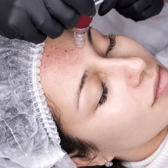 How Much Microneedling Treatment Cost in Riyadh