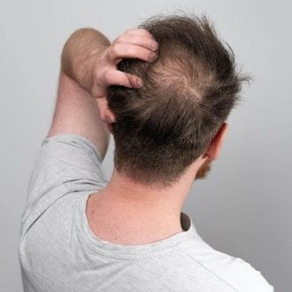 Stem Cell Hair Transplant Cost