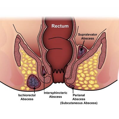 Fistula Surgery in Riyadh