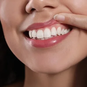 Gingivectomy Cost