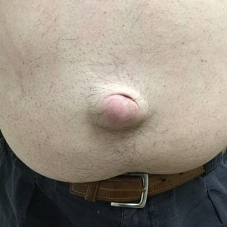 Hernia Surgery Cost