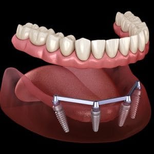 Dental Implants Cost
