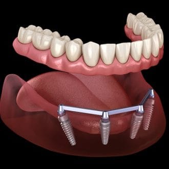 Dental Implants Cost