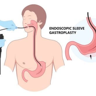 Endoscopic Sleeve Gastroplasty Cost