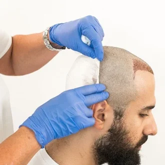 FUSS Hair Transplant Cost