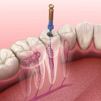 Root Canal Treatment Cost