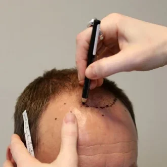 Hair Transplant Cost