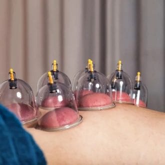 Hijama For Migraine