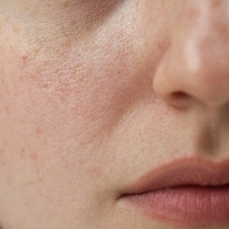 Large Pores Treatment Cost