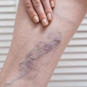 Varicose Veins Treatment Price