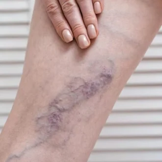 Varicose Veins Treatment Price