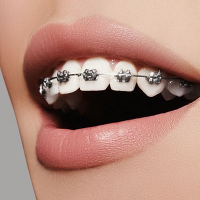 Cheap Dental Braces in Riyadh