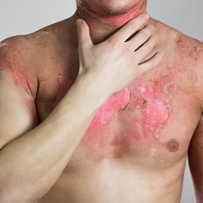 Burn Reconstructive Surgery