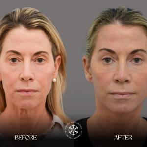 Blephroplasty Before After