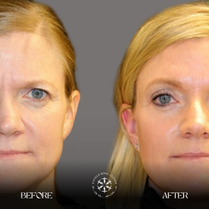 Blepjroplasty Results