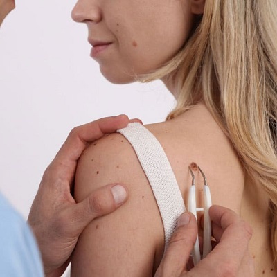 Dermoscopy Mole Evaluation in Riyadh