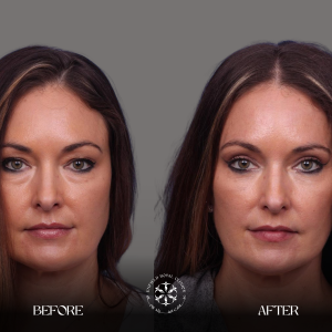 Eyelid Surgery Before After