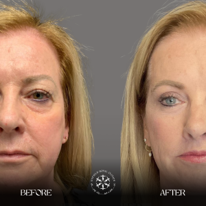 Eyelid Surgery Resulsts