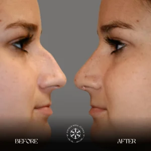 Rhinoplasrt Before After Results