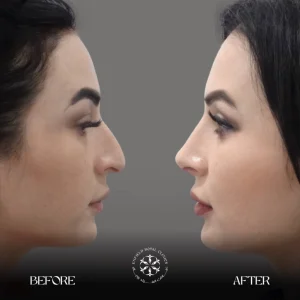 Rhinoplasty Before After