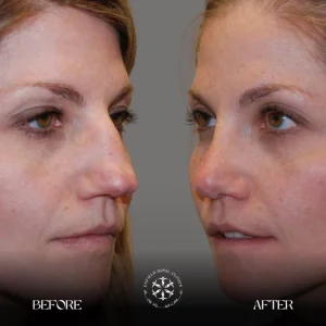 Rhinoplasty Surgery Results