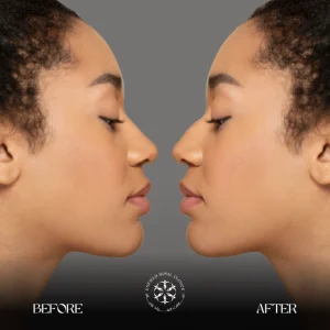 rhinoplasty surgery before after