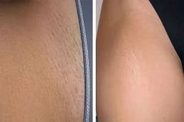 Bikini laser hair removal saudi
