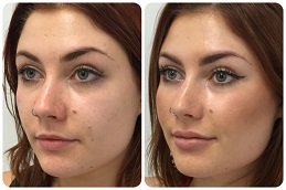 SKIN BOOSTER IN RIYADH COST & PRICE