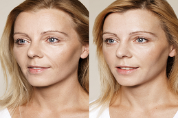 Skin Booster in Riyadh COST