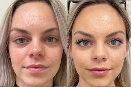 Skin Booster in Riyadh & SAUDI