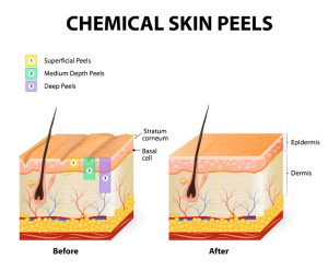 chemical-skin-peel-diagram-in-Riyadh