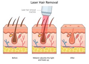 laser hair removal before & after