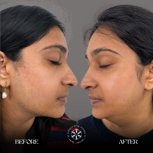 laser hair removal before and after