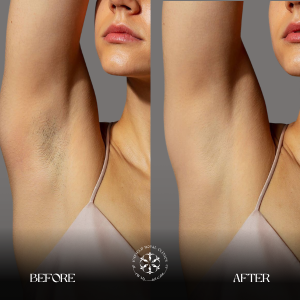 laser hair removal results