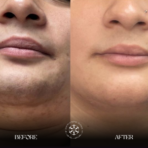 laser removal after results