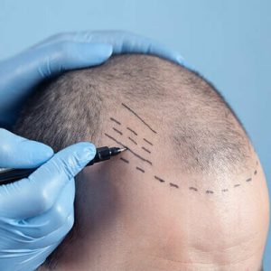 4000 or 5000 grafts hair transplant cost in Riyadh