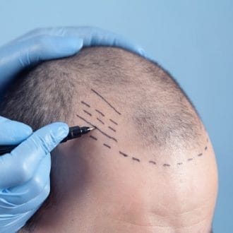 4000 Or 5000 Graft Hair Transplant Cost In Riyadh