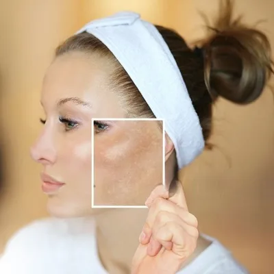 glutathione mesotherapy for melasma Hormonal Pigmentation | Melasma Treatment in Riyadh &