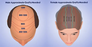 What Does 4000 or 5000 Grafts Look Like