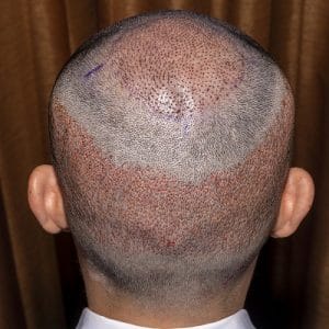 Hair Transplant Cost in Buraydah & Al Qassim