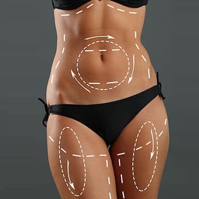 Liposuction in Riyadh from 6,999 SAR Saudi Offers