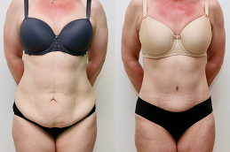 non surgical tummy tuck